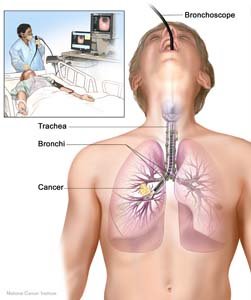 Is Mesothelioma Cancer?